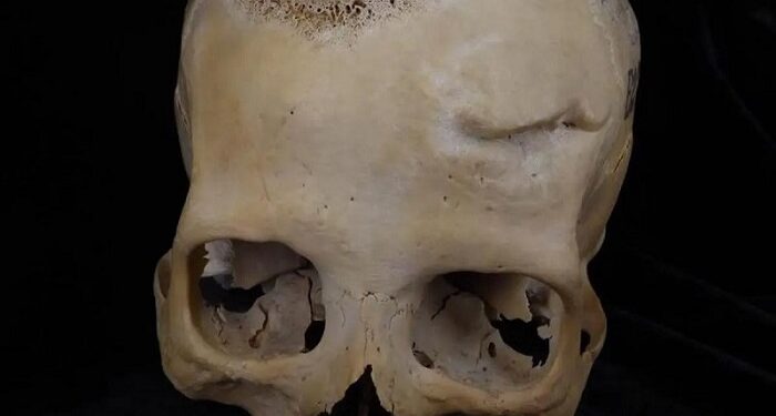Hallan pruebas de que el primer paciente operado de cáncer vivió hace 4.500 años en el Antiguo Egipto