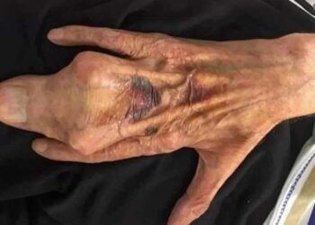 ¿Cómo es una mano humana con SINDACTILIA?
