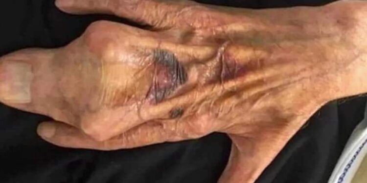 ¿Cómo es una mano humana con SINDACTILIA?