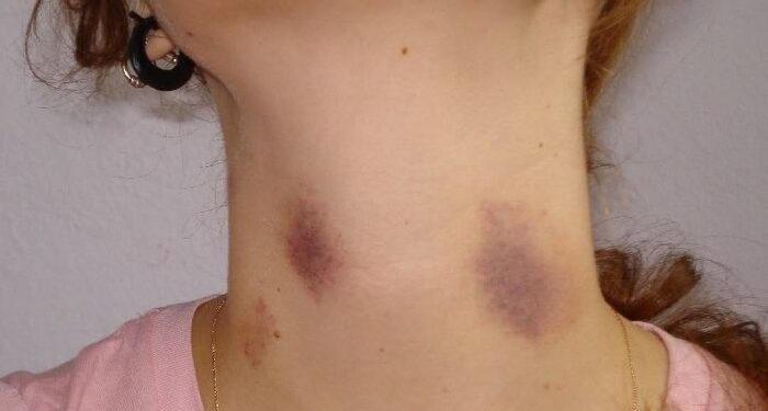 Un chupetón en el cuello podría ser mortal