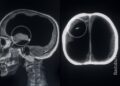 El hombre que vivió casi sin cerebro y nadie lo notó durante 44 años