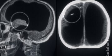 El hombre que vivió casi sin cerebro y nadie lo notó durante 44 años