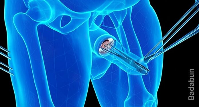 Tres datos de la circuncisión que toda mujer debe saber