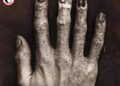 Así se veía la mano de un técnico de Rayos X antes del Siglo XX