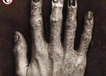Así se veía la mano de un técnico de Rayos X antes del Siglo XX
