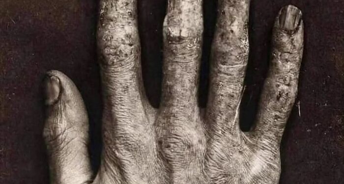 Así se veía la mano de un técnico de Rayos X antes del Siglo XX