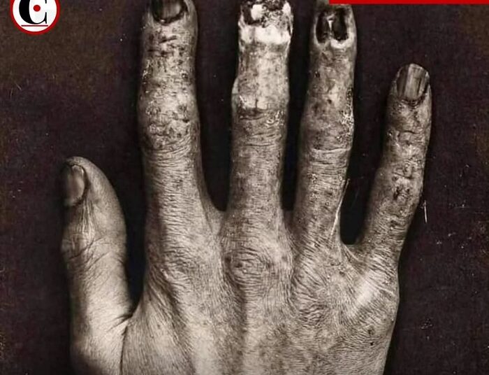 Así se veía la mano de un técnico de Rayos X antes del Siglo XX